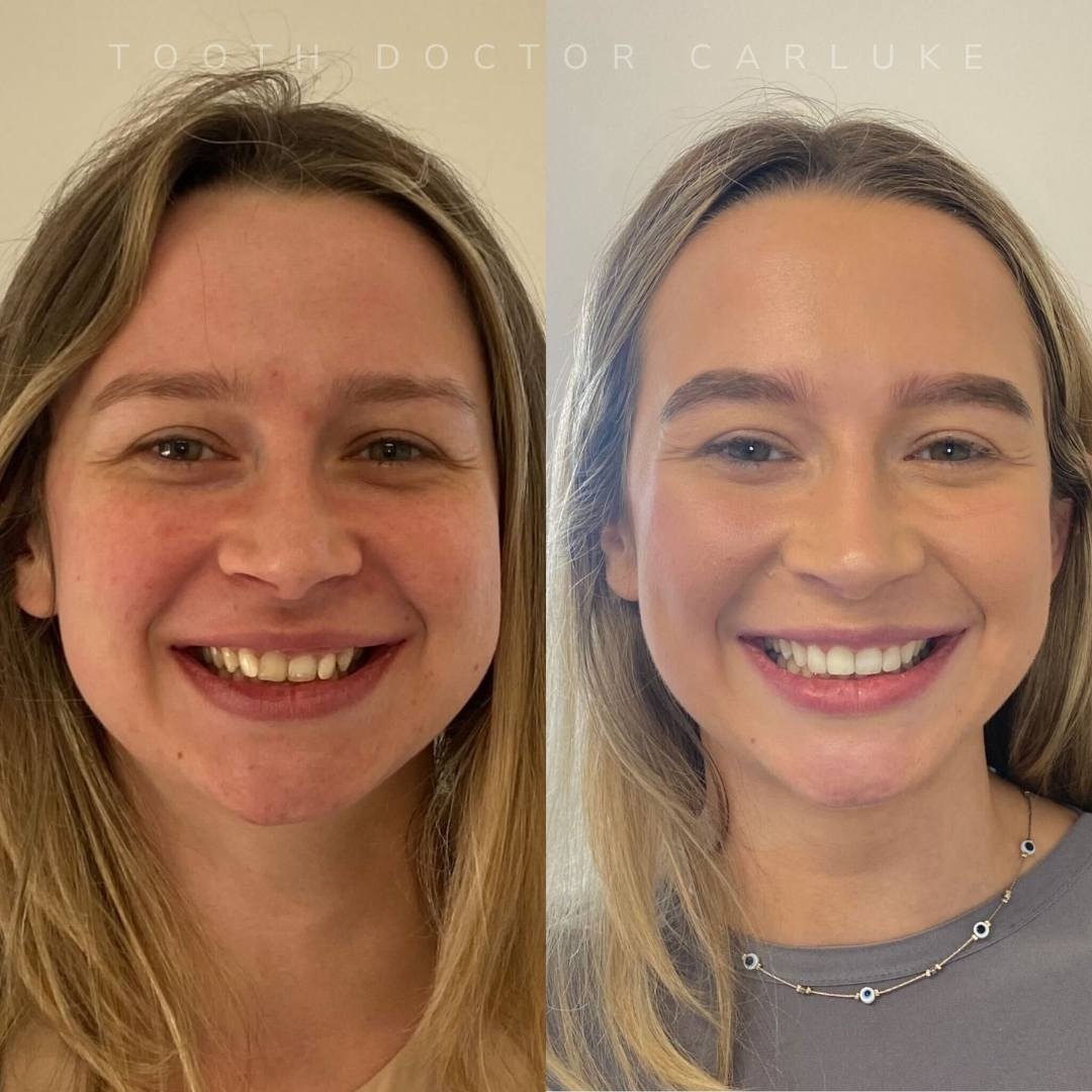 Tooth Doctor | Smile Gallery Before and after treatment