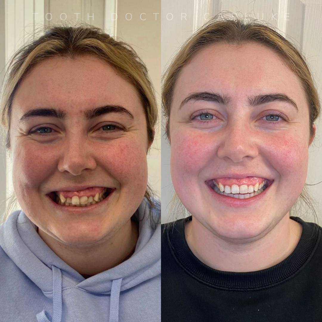 Tooth Doctor | Smile Gallery Before and after treatment