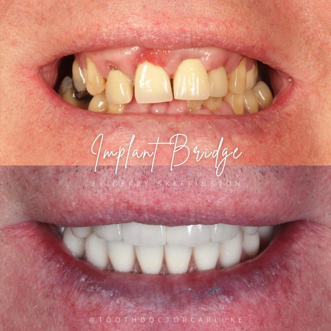 Tooth Doctor | Request A Complimentary Consultation Before and after treatment at Tooth Doctor in Carluke