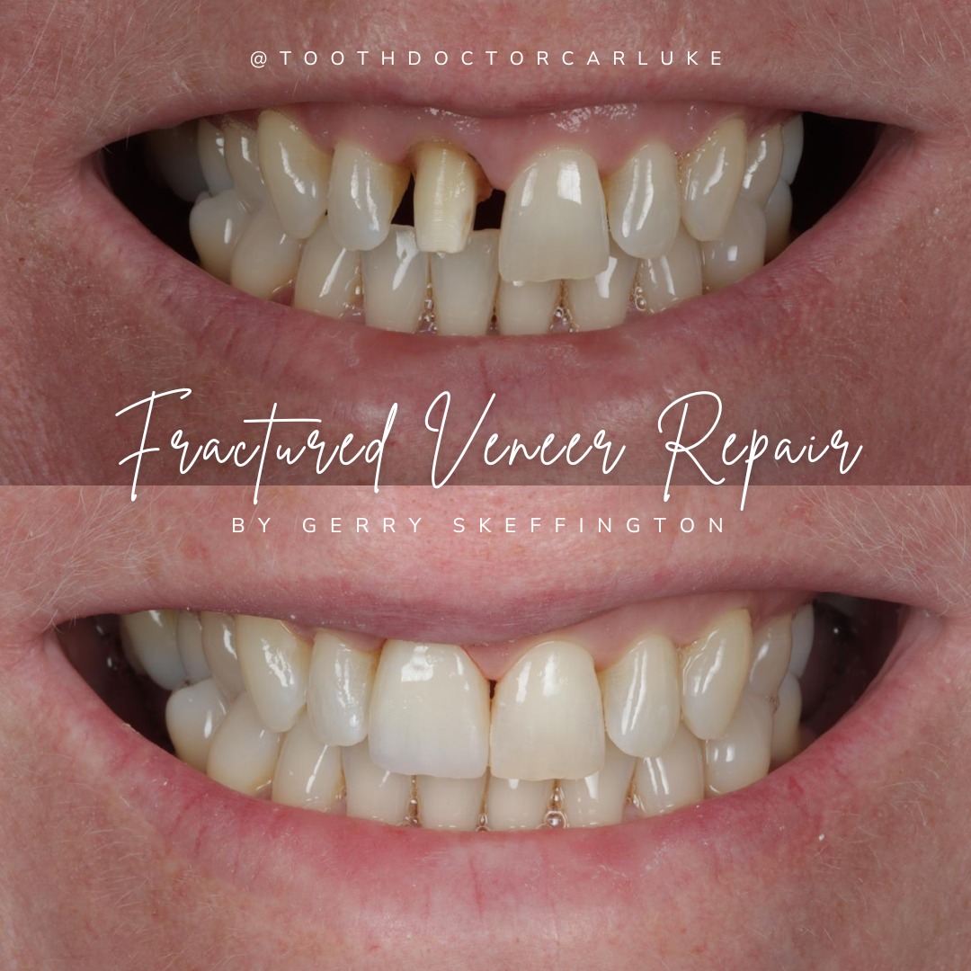 Tooth Doctor | Request A Complimentary Consultation Before and after treatment at Tooth Doctor in Carluke