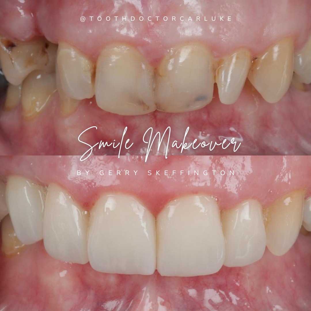 Tooth Doctor | Request A Complimentary Consultation Before and after treatment at Tooth Doctor in Carluke