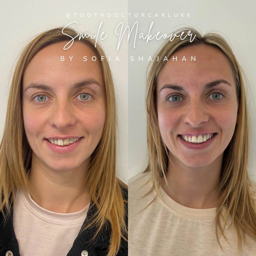 Tooth Doctor | Smile Gallery Before and after treatment